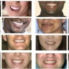 Maatskappy 1 beeld COST OF A DENTAL IMPLANT AND COST OF A DENTAL CROWN Wisdom Tooth Extraction in Sandton GP